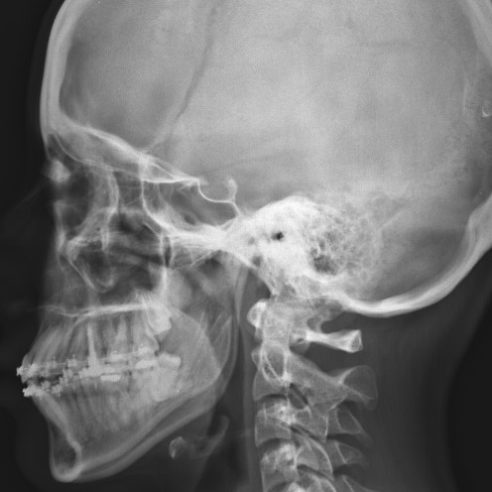 radiografía de adenoides